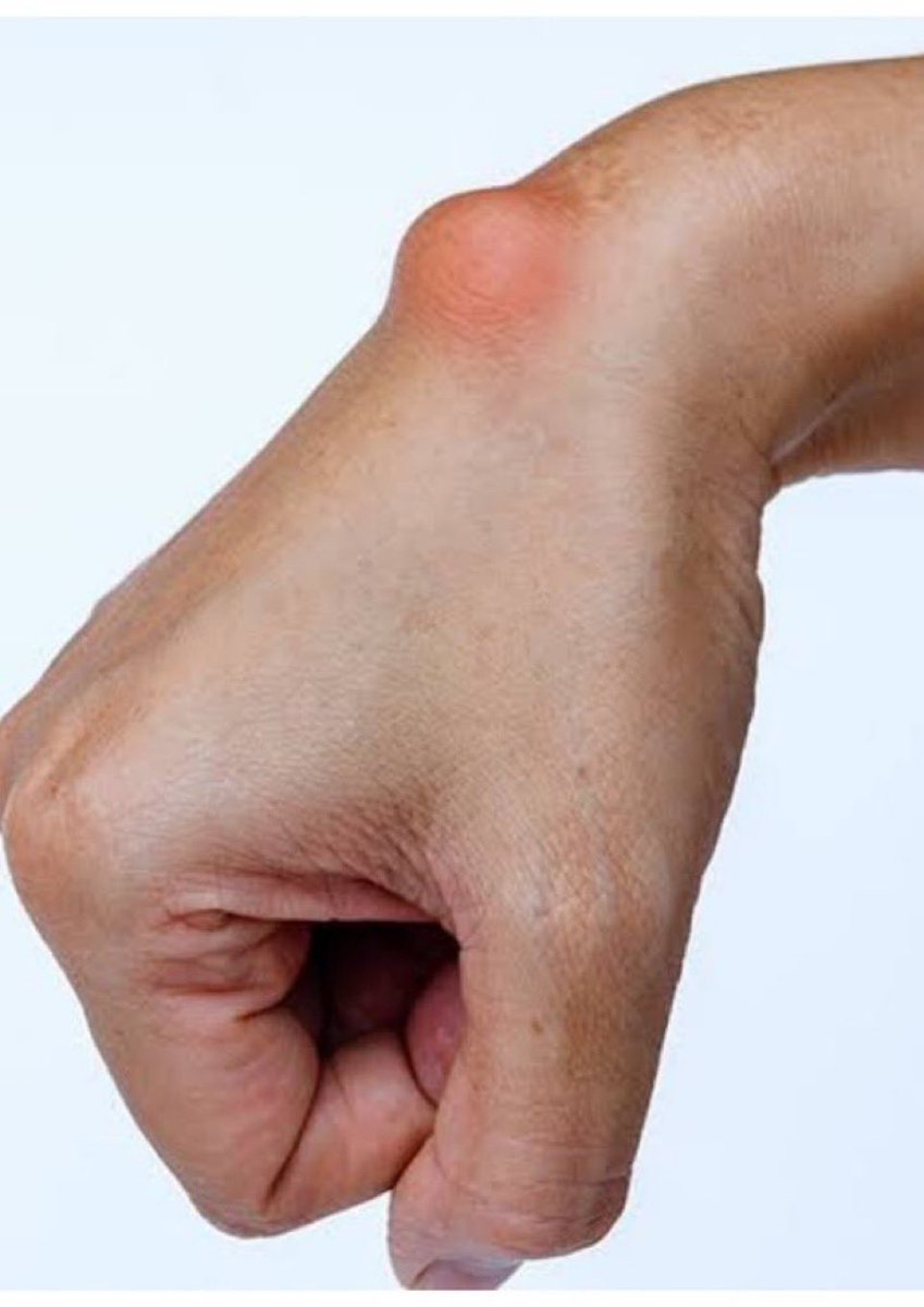 This small swelling is common on the wrist and it is called ganglion cyst. 

Ganglion cysts are small non-cancerous lumps that appear below your skin, often near joints or tendons. 

The cysts are usually  filled with a thick, jelly-like fluid, with their sizes varying from very
