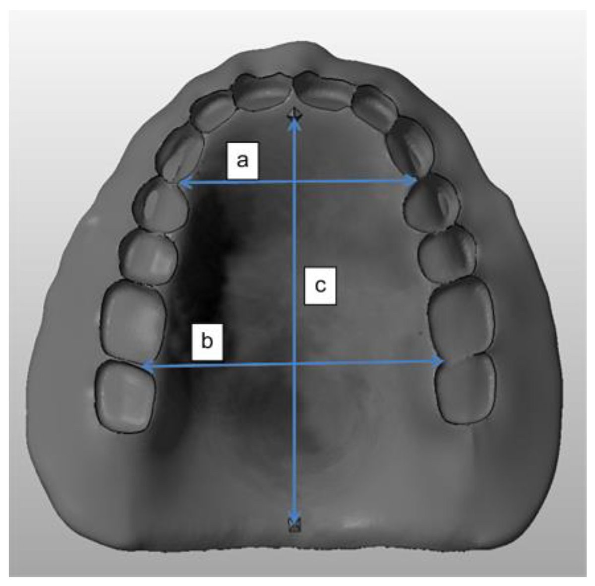Applsci's tweet photo. π₯ Read our Paper
π Four Different #BuildAngles in #3DPrinted Complete #Denture Bases: A Comparative In Vitro Study
π https://t.co/cqE8P0wG6F
π¨βπ¬ by Dr. Ki Won Kim et al.
π« Veterans Health Service Medical Center / @yonsei_u https://t.co/EeMg0Chfv1