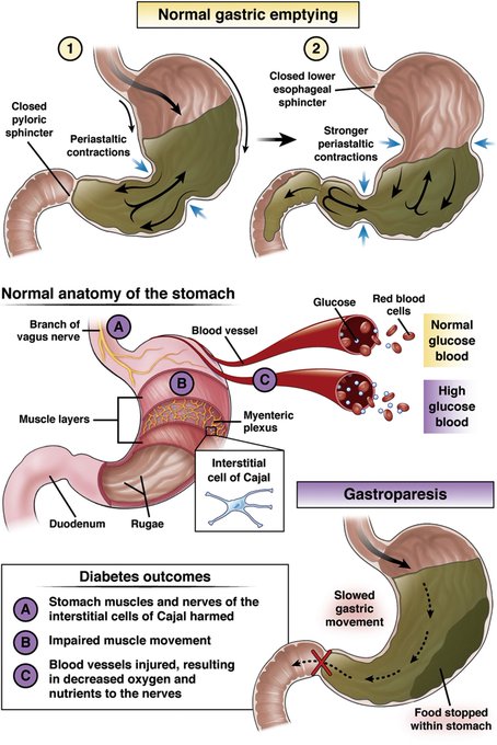 Gastroparesia diabética #4KMedEd #GITwitter (vía <a href="/AGA_CGH/">CGH</a>)