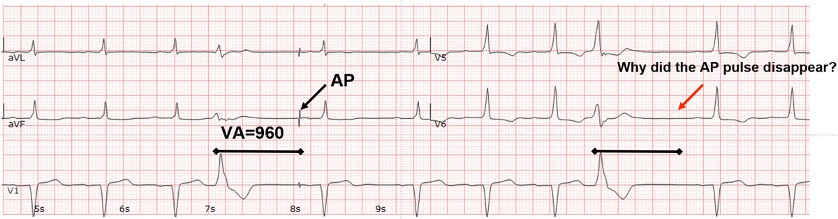 Basic Q&amp;A on pacing cycles: Why isn't the AP pulse coming out? Is the pacemaker malfunctioning?