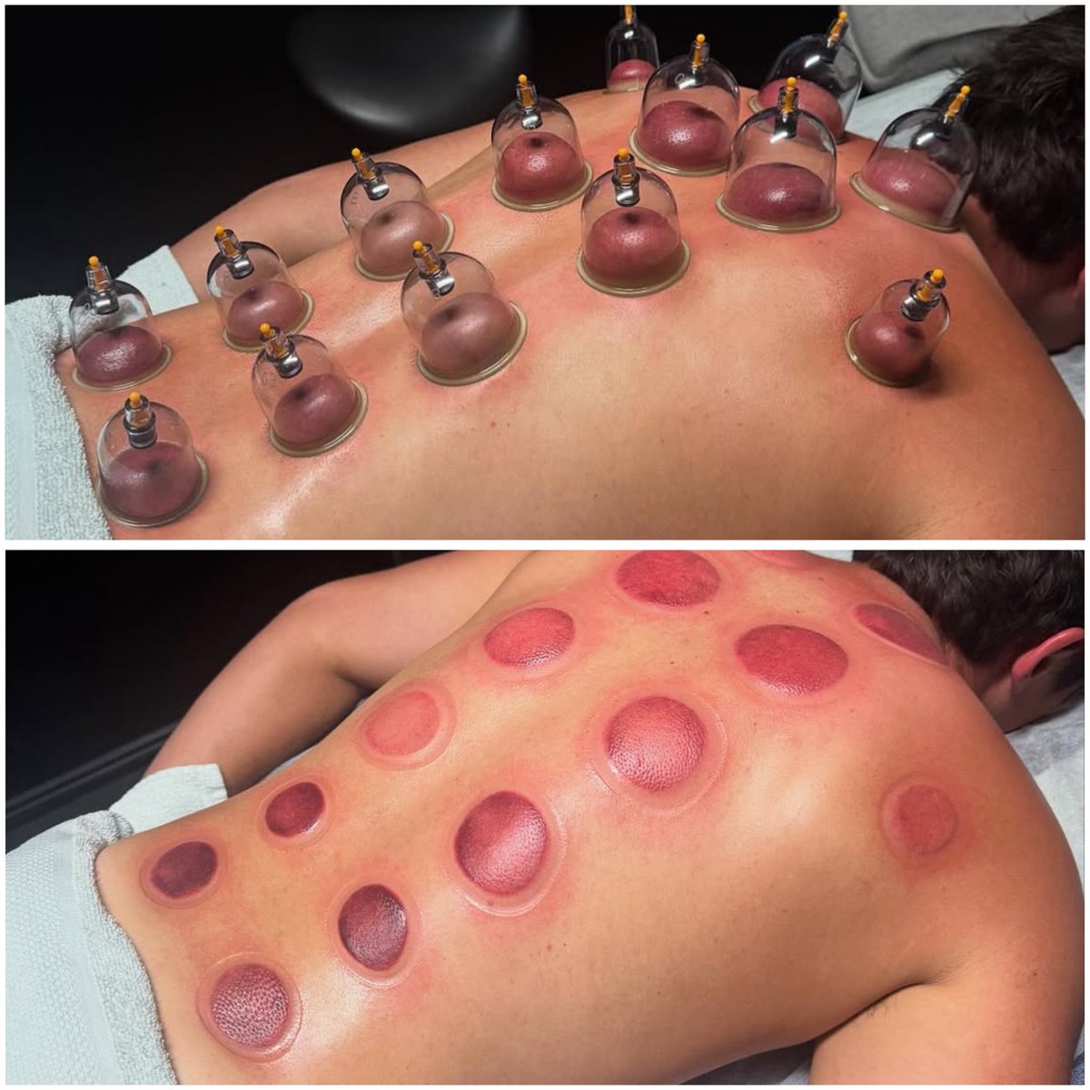 BlueWaxing Biên Hoà đang cần 2 bạn mẫu Cupping trị liệu miễn phí.
• Không yêu cầu hình thể
• Ưu tiền HS SV hoặc anh em có công việc nặng
• Có ghi hình quá trình trị liệu (không face)
Anh em ai cần thì inbox!