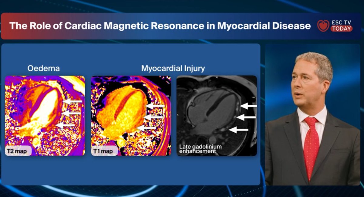 European Society of Cardiology (@escardio) on Twitter photo How can #CMR help diagnose myocarditis, cardiomyopathies, and heart issues related to long COVID?
In this #ESCTVToday episode, <a href="/s_e_petersen/">Steffen Petersen</a> explains how CMR accurately identifies these conditions, guides treatment, & differentiates between different types of cardiomyopathy, How can #CMR help diagnose myocarditis, cardiomyopathies, and heart issues related to long COVID?
In this #ESCTVToday episode, <a href="/s_e_petersen/">Steffen Petersen</a> explains how CMR accurately identifies these conditions, guides treatment, & differentiates between different types of cardiomyopathy,