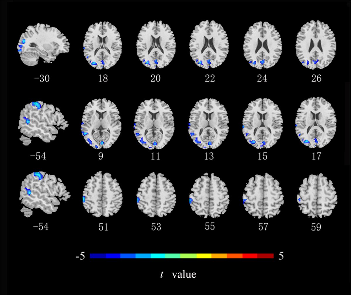 Kate Liu (@kateliu08703628) on Twitter photo 🌟 <a href="/JINeuroscience/">Journal of Integrative Neuroscience</a> Resting-State Brain Function Alteration in Colorectal Cancer Patients
imrpress.com/journal/JIN/23…
#colorectalcancer #CRC #functional_brainactivity #restingstate #fMRI #brain #neurology 🌟 <a href="/JINeuroscience/">Journal of Integrative Neuroscience</a> Resting-State Brain Function Alteration in Colorectal Cancer Patients
imrpress.com/journal/JIN/23…
#colorectalcancer #CRC #functional_brainactivity #restingstate #fMRI #brain #neurology