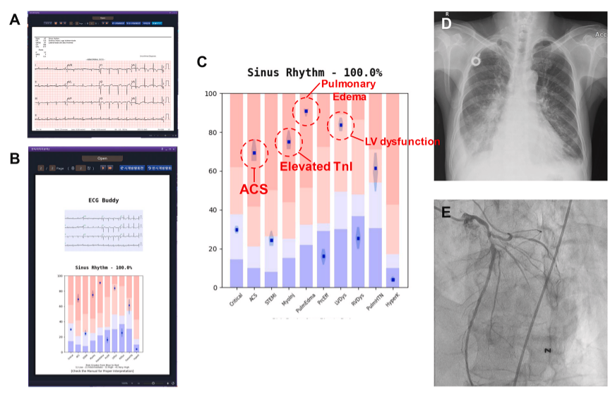 Giuseppe Biondi-Zoccai (@gbiondizoccai) on Twitter photo Artificial intelligence and the electrocardiogram: A modern renaissance, by Palermi et al sciencedirect.com/science/articl… Artificial intelligence and the electrocardiogram: A modern renaissance, by Palermi et al sciencedirect.com/science/articl…
