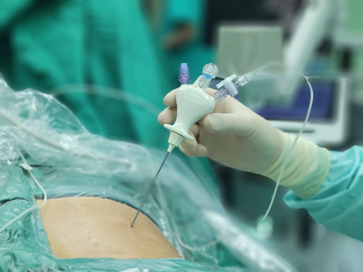 Tsinghua Medicine (@medtsinghua) on Twitter photo 28 surgeries a day. 3 minutes to establish a surgical tract. 100% pediatric success rate. Prof Li Jianxing is redefining kidney stone surgery with precision, innovation, and #AI. <a href="/Tsinghua_Uni/">Tsinghua University</a> 28 surgeries a day. 3 minutes to establish a surgical tract. 100% pediatric success rate. Prof Li Jianxing is redefining kidney stone surgery with precision, innovation, and #AI. <a href="/Tsinghua_Uni/">Tsinghua University</a>