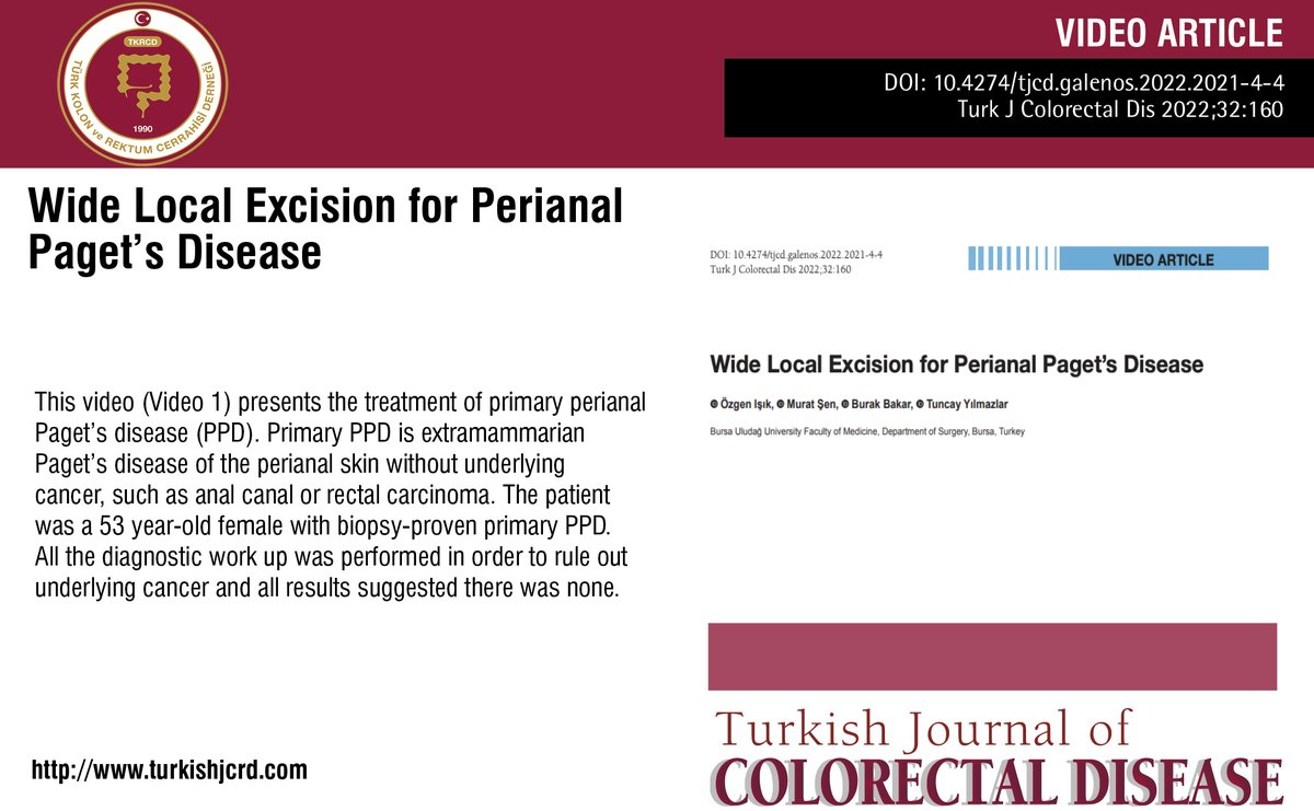 Wide Local Excision for Perianal Paget’s Disease

You can see the free full text of the research by Özgen Işık et al.

turkishjcrd.com/articles/wide-…

youtube.com/watch?v=SuH72g…
