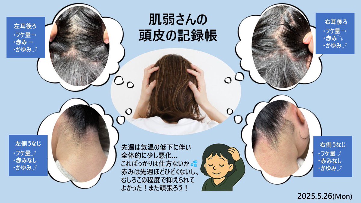 hadayowa_san's tweet photo. 頭皮の記録帳更新📝
気温が下がったおかげでかゆみ爆発⚡
最高気温8℃の日もあったもんね😂旦那に寝ながらすごい頭かいてたよと言われた💦フケは増えたけどヒリつきと赤みは少し減ったし最悪って程ではないから良し！
カダソンが抑えてくれたのかな🧴🫧
よく耐えたね頭皮！

#脂漏性皮膚炎 https://t.co/vCbiJZJYNA