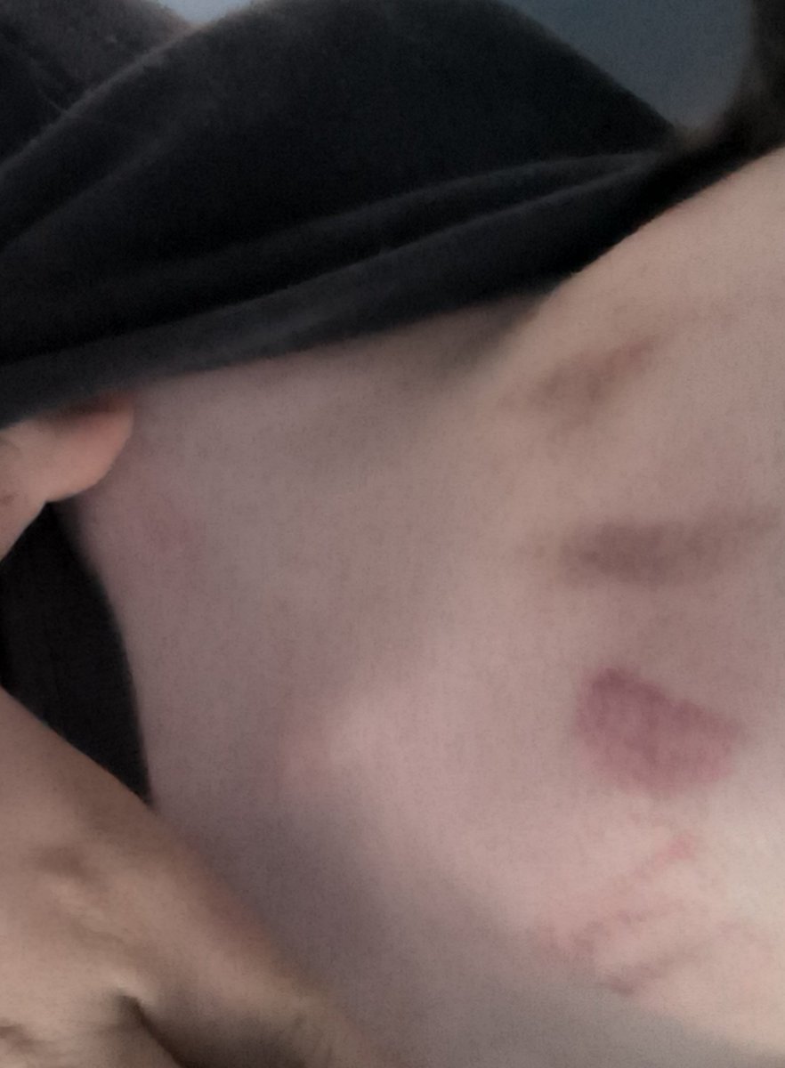 Bigcutes1's tweet photo. Bite marks:333 https://t.co/CjMofMovfD