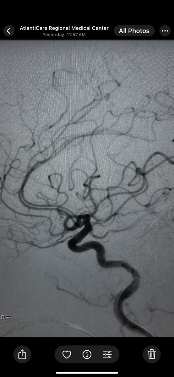 Multimodal training is a must for contemporary cerebrovascular surgeons to avoid bias in making treatment decisions, but in the right hands, there are very few ruptured aneurysms that require clips. As shown in this ruptured pcomm #cerebrovascular #neurosurgery #aneurysm