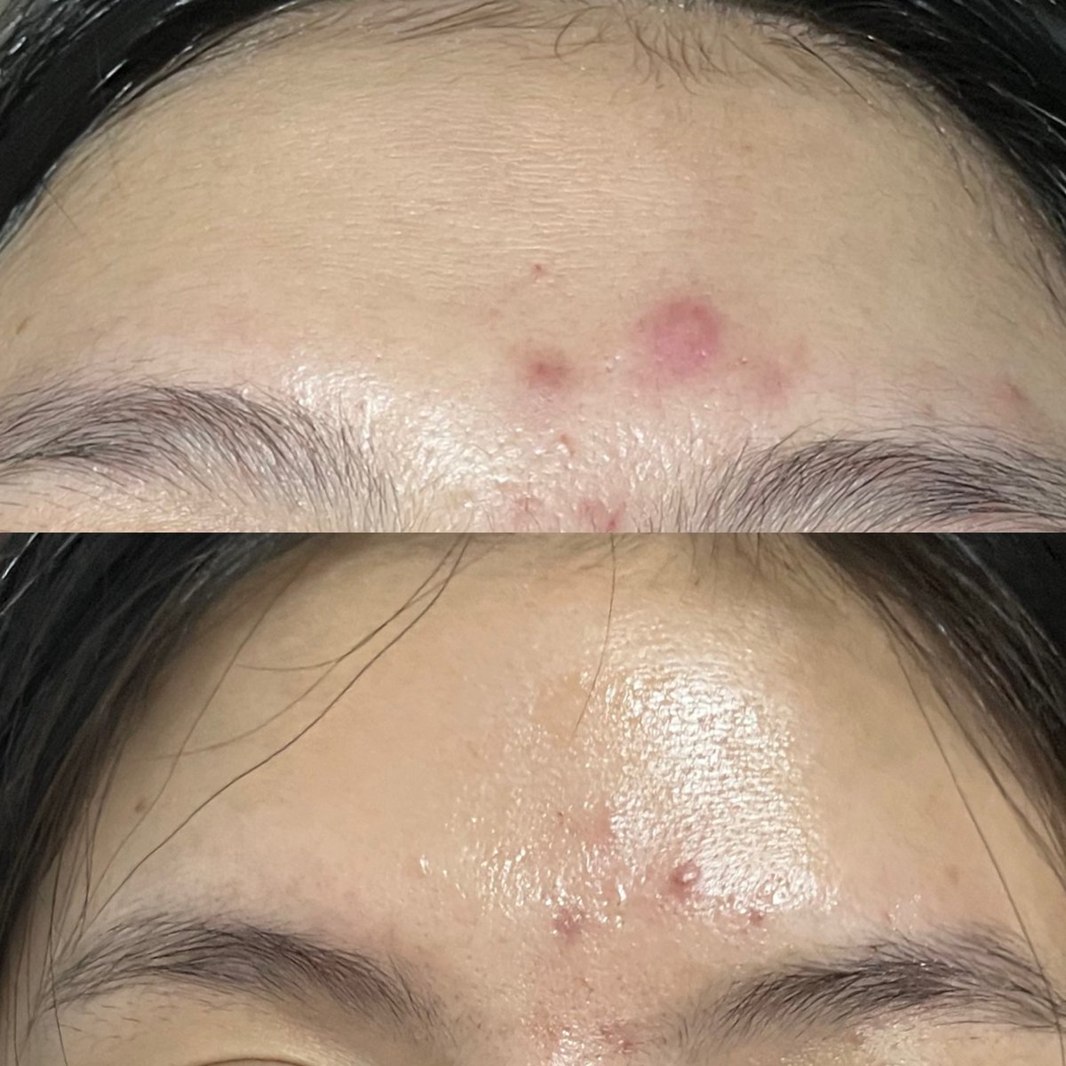 imwntn_'s tweet photo. ใช้ตาม @chin_skinnerd สิวบุก พกหลอดเดียวจบ เจลแต้มสิวฟาร์มูลา สูตรเภสัช ใช้ได้กับสิวทุกชนิด ไม่ว่าจะสิวอักเสบ สิวอุดตัน สิวหัวช้าง เข้มข้นแต่อ่อนโยน แต้มไปแค่ 3 วันรู้เรื่องเลย เม็ดใหญ่ขนาดนี้ ยุบหาย ไม่เหลือไต 100/10 👀 #pharmular #ฟาร์มูล่า #เจลแต้มสิว https://t.co/FCMorc2t51