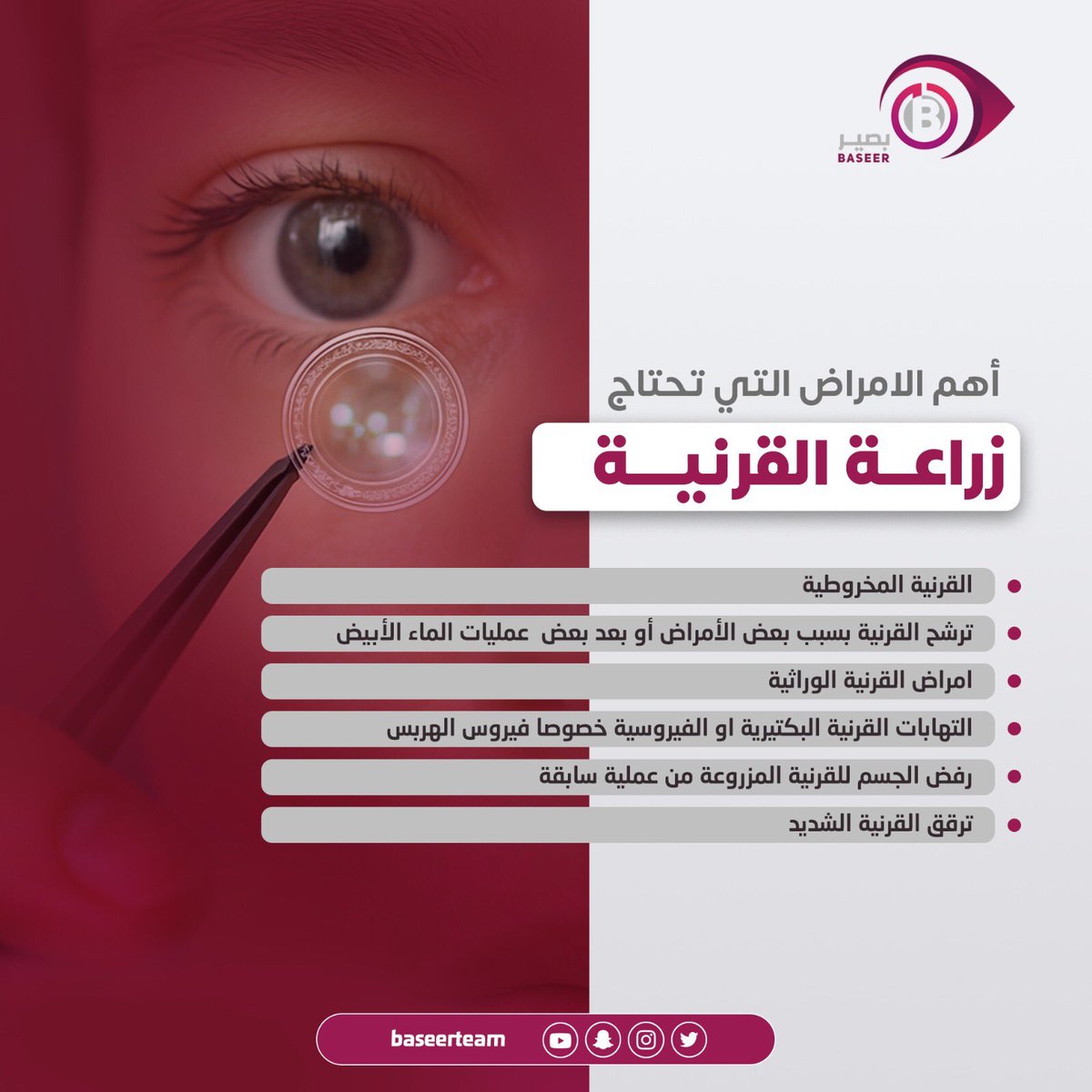 زراعة القرنية : 
هي عملية جراحية يتم فيها ازالة القرنية المريضة أو جزء منها  واستبدالها بقرنية سليمة طبيعية متبرع بها ...

تعرف على أهم الامراض التي تحتاج زراعة قرنية .. ⬇️