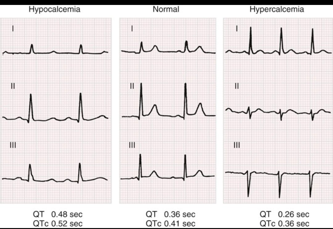 Electrolytes &amp; ECG: Calcium &amp; the QT Interval 😍
Calcium levels influence phase 2 of the cardiac action potential, which directly affects the QT interval:
⬜ ↓ Ca²⁺ = delayed repolarization = long QT
⬜ ↑ Ca²⁺ = faster repolarization = short QT
⬜ Normal Ca²⁺ = balanced
