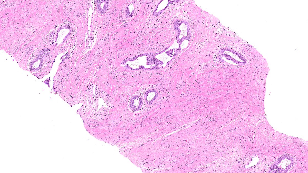 Let’s review spindled lesions of breast this week!

Case of Fascicular Pseudoangiomatous Stromal Hyperplasia (PASH) 🔬

This PASH variant shows fascicular bundles of myofibroblasts &amp; mimics other spindled tumors.

Have a meaningful Memorial Day 🇺🇸

#PathX #PathTwitter #breastpath