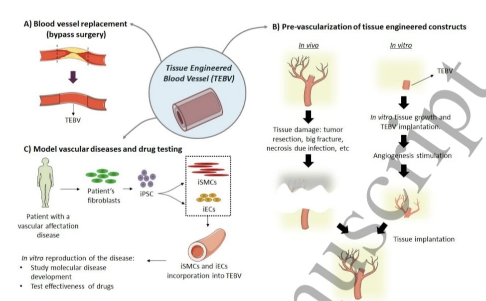 jcrivasferr's tweet image. Could #tissue #Engineering of #blood #vessels eliminate the use of #saphenous #veins and #LIMA in future #bypass #surgeries? 🔬🐁🧬

If #fibroblasts from a patient with vascular disease can be extracted and reprogrammed into in vitro #pluripotent #stem #cells (#iPSCs), then