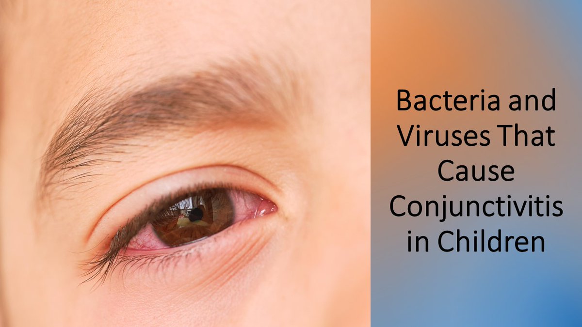 NEJM Journal Watch (@jwatch) on Twitter photo Conjunctival swabs were collected and tested from 194 children with acute infectious conjunctivitis and 196 age-matched controls. Of 52 tested pathogens, only one was associated with conjunctivitis. Read more: jwat.ch/4mkfc9w
#conjunctivitis <a href="/ClementLeeMD/">Clement Lee, MD, MSc</a> #pediatrics Conjunctival swabs were collected and tested from 194 children with acute infectious conjunctivitis and 196 age-matched controls. Of 52 tested pathogens, only one was associated with conjunctivitis. Read more: jwat.ch/4mkfc9w
#conjunctivitis <a href="/ClementLeeMD/">Clement Lee, MD, MSc</a> #pediatrics