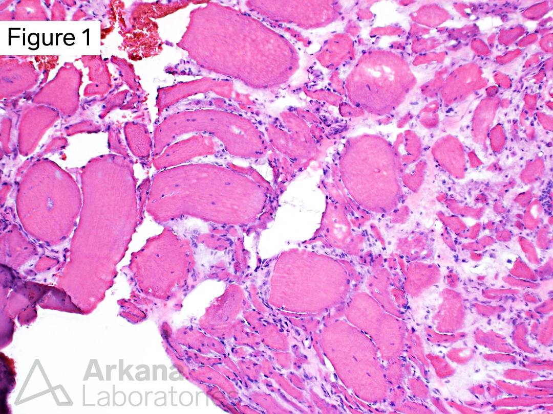 arkanalabs's tweet photo. This 75-year-old patient presented with slowly progressive generalized muscle weakness of approximately 2 years’ duration.
What is your diagnosis based images from figures #1 - #4?
#NeuroNotes #neuropath #pathology #neuromuscularpath https://t.co/vJwYnObl19