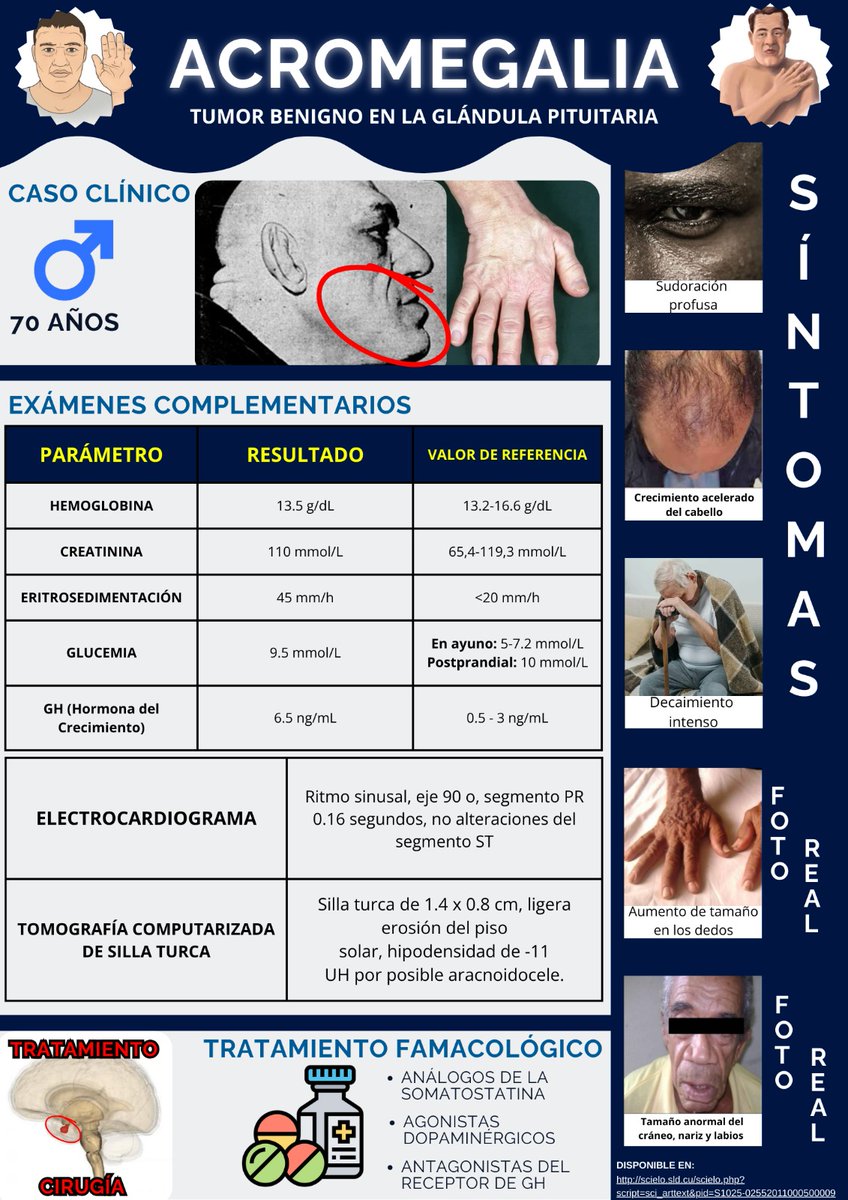_MikeBlue's tweet photo. Cordiales Saludos 🩷
Es para mi un honor compartir con ustedes este poster científico que realicé sobre una enfermedad conocida como "Acromegalia", espero con mucho honor que sea de su agrado.
#UleamEsAcademia #UleamEnBuenasManos @Anghelo77ac @UleamEcuador
https://t.co/YotYYMNbiQ https://t.co/gIBC3vPLJX