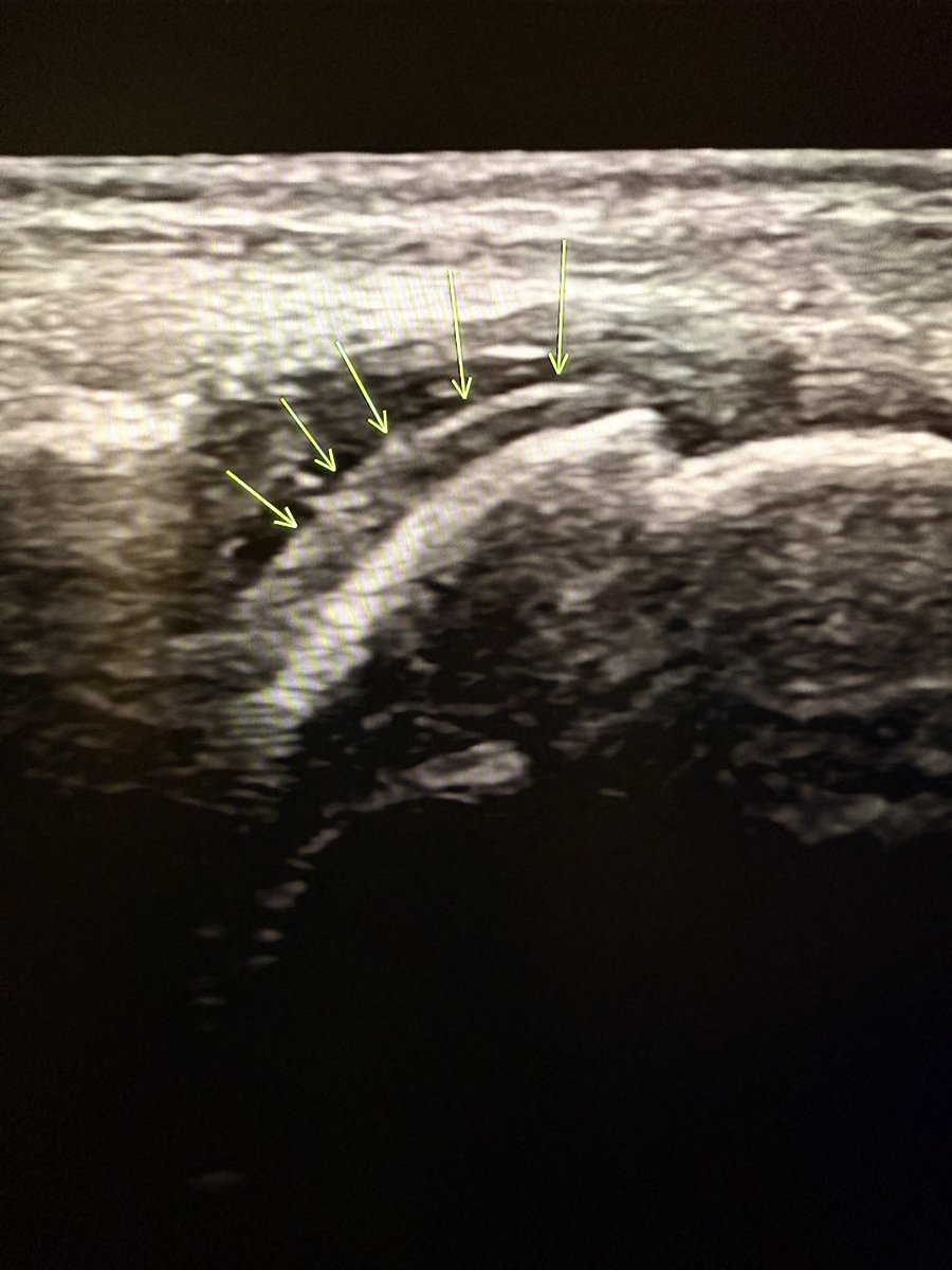 Double contour sign! 

It is a sonographic sign specific for gouty arthritis. 

Why does it occur?

In gout, monosodium urate crystals deposit on the surface of the hyaline cartilage within the joint. 

This results in two distinct echogenic lines:

1.Deep line = normal
