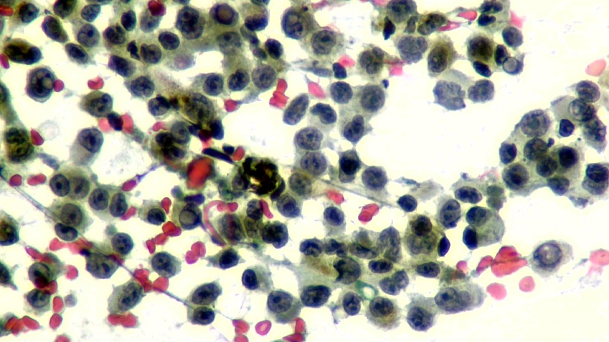 Lola Lozano (@mdlozanoe) on Twitter photo Melanoma: scatterd cells, INCIs, nucleoli, and fine cytoplasmic melanocyte pigment 🧐🔬🕳️
<a href="/IACytology/">International Academy Cytology</a> <a href="/CytologyEFCS/">EFCS</a> <a href="/EfcsYoung/">Young EFCS</a> <a href="/SECitologia/">Sociedad Española de Citología</a> <a href="/SEAP_IAP/">SEAP-IAP</a> <a href="/cytopathology/">Cytopathology.org</a> Melanoma: scatterd cells, INCIs, nucleoli, and fine cytoplasmic melanocyte pigment 🧐🔬🕳️
<a href="/IACytology/">International Academy Cytology</a> <a href="/CytologyEFCS/">EFCS</a> <a href="/EfcsYoung/">Young EFCS</a> <a href="/SECitologia/">Sociedad Española de Citología</a> <a href="/SEAP_IAP/">SEAP-IAP</a> <a href="/cytopathology/">Cytopathology.org</a>