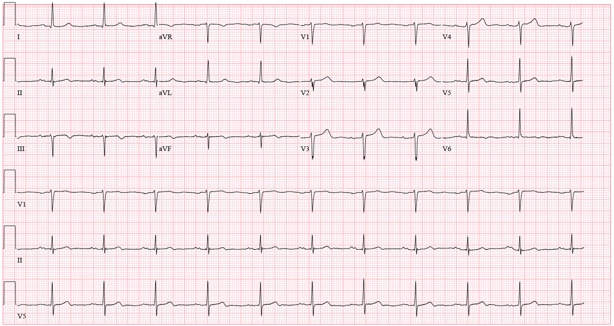 Stephen W. Smith (@smithecgblog) on Twitter photo What happens when a clinic does not have troponin testing for chest pain patients? Stress testing?
hqmeded-ecg.blogspot.com/2025/05/what-h…
<a href="/willyhfrick/">Willy Frick</a> What happens when a clinic does not have troponin testing for chest pain patients? Stress testing?
hqmeded-ecg.blogspot.com/2025/05/what-h…
<a href="/willyhfrick/">Willy Frick</a>