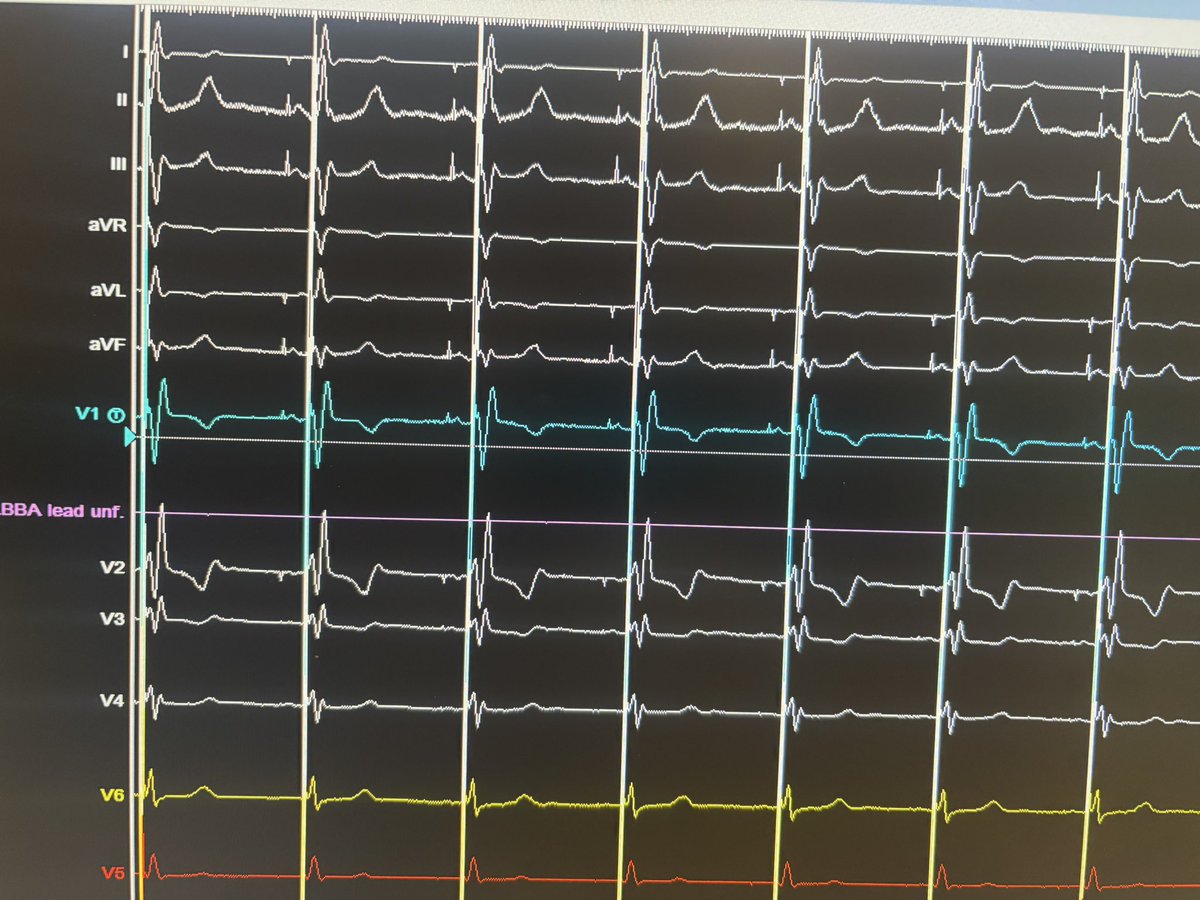 Kevin Vernooy (@kvernooy) on Twitter photo Another case of optimized pacing: LBBP + BBP with optimized heart rate, PR interval resulting in narrow P wave and QRS duration.
<a href="/Marek_Jastrz_EP/">Marek Jastrzębski</a> <a href="/ZacharyWhinnett/">Zachary Whinnett</a> <a href="/Hisdoc1/">Pugal Vijayaraman</a> <a href="/Dr_JozaEP/">Jacqueline Joza</a> <a href="/Dominik_Linz/">Dominik Linz</a> <a href="/gauravaupadhyay/">Gaurav A. Upadhyay</a> <a href="/UyenChauNguyen1/">Uyen Chau Nguyen</a> Another case of optimized pacing: LBBP + BBP with optimized heart rate, PR interval resulting in narrow P wave and QRS duration.
<a href="/Marek_Jastrz_EP/">Marek Jastrzębski</a> <a href="/ZacharyWhinnett/">Zachary Whinnett</a> <a href="/Hisdoc1/">Pugal Vijayaraman</a> <a href="/Dr_JozaEP/">Jacqueline Joza</a> <a href="/Dominik_Linz/">Dominik Linz</a> <a href="/gauravaupadhyay/">Gaurav A. Upadhyay</a> <a href="/UyenChauNguyen1/">Uyen Chau Nguyen</a>