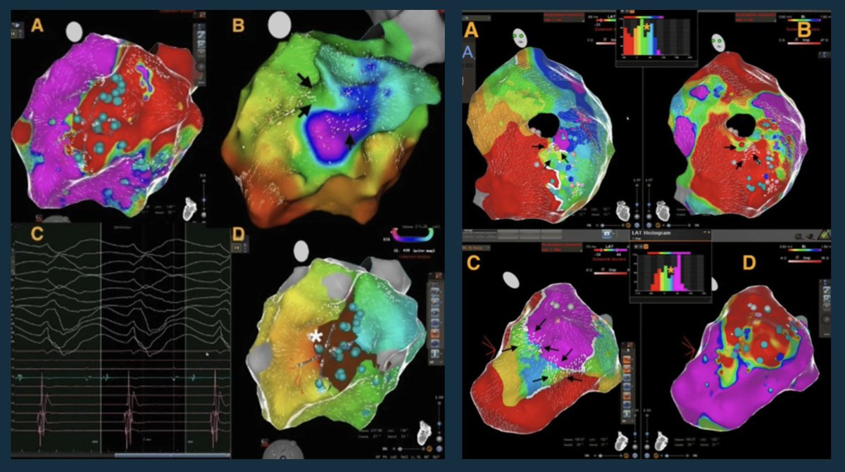 JICE (@jice_ep) on Twitter photo 🚨New #FreeRead Article in
<a href="/JICE_EP/">JICE</a>
Significance of Coherent Mapping in Unveiling Slow Conduction Zones of VT Substrate in Ischemic Cardiomyopathy
🧐📖 rdcu.be/enLPP
by <a href="/YalinKivanc/">Kıvanç YALIN</a>, Baris İkitimur, <a href="/aliugursoysal/">Ali Uğur Soysal</a>, Hakan Yalman, Arda Ceviker, Sukran Nur Sanli, Ahmet 🚨New #FreeRead Article in
<a href="/JICE_EP/">JICE</a>
Significance of Coherent Mapping in Unveiling Slow Conduction Zones of VT Substrate in Ischemic Cardiomyopathy
🧐📖 rdcu.be/enLPP
by <a href="/YalinKivanc/">Kıvanç YALIN</a>, Baris İkitimur, <a href="/aliugursoysal/">Ali Uğur Soysal</a>, Hakan Yalman, Arda Ceviker, Sukran Nur Sanli, Ahmet