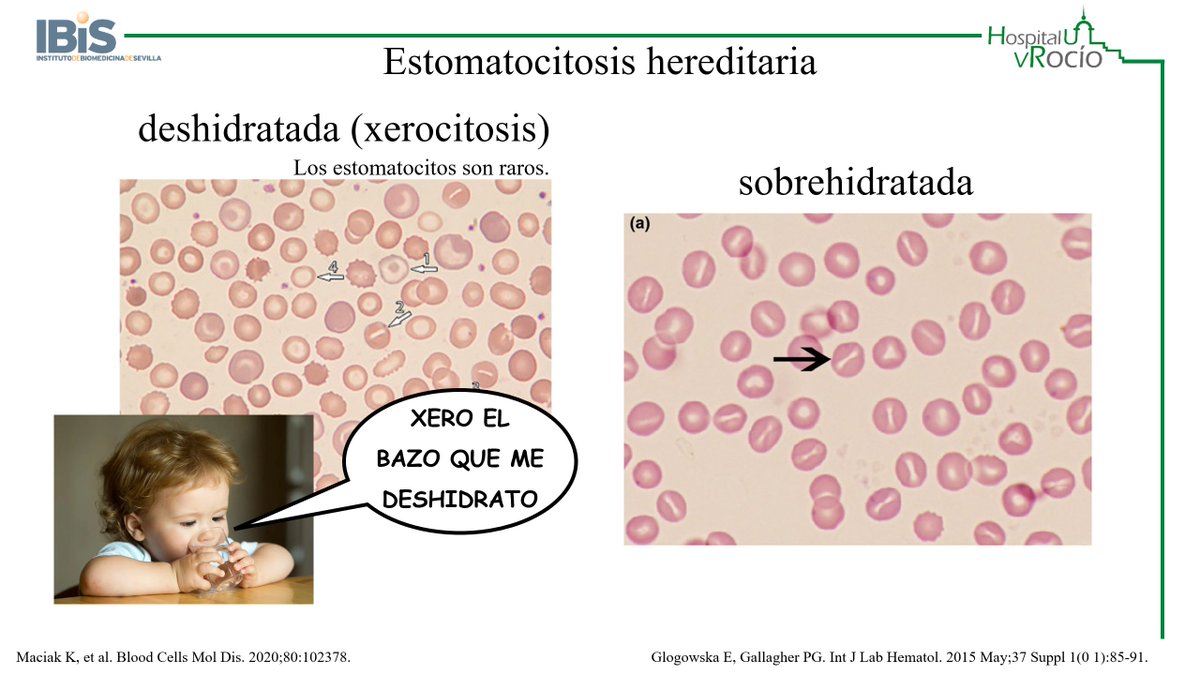salvadorpayan's tweet image. Recordad que en la #xerocitosis hereditaria, la esplenectomía está contraindicada por el alto riesgo de trombosis. Lo preguntaron en las oposiciones de @saludand de 2021.

P.D.: No faltéis mañana 27/05 al repaso de #Eritropatología del curso que organiza @Amgen para la OPE.