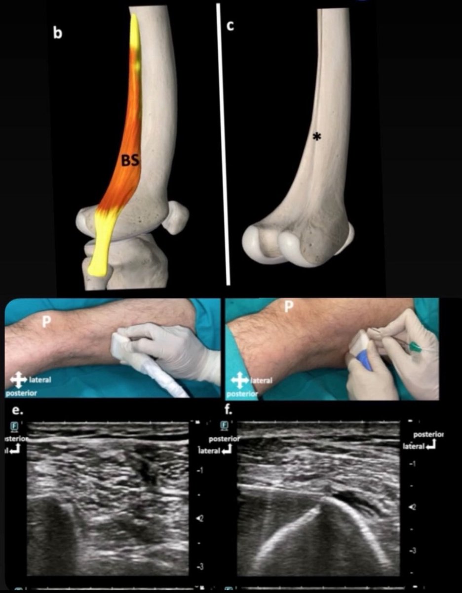 A new regioanal anesthetic technique for managing posterolateral knee pain: Biceps Femoris Short Head (BiFeS) Block.BiFeS block may offer a motor-sparing analgesic option for post-TKA, in the supine position .#kneepain <a href="/SerkanTulgarMD/">Tulgar S</a>
