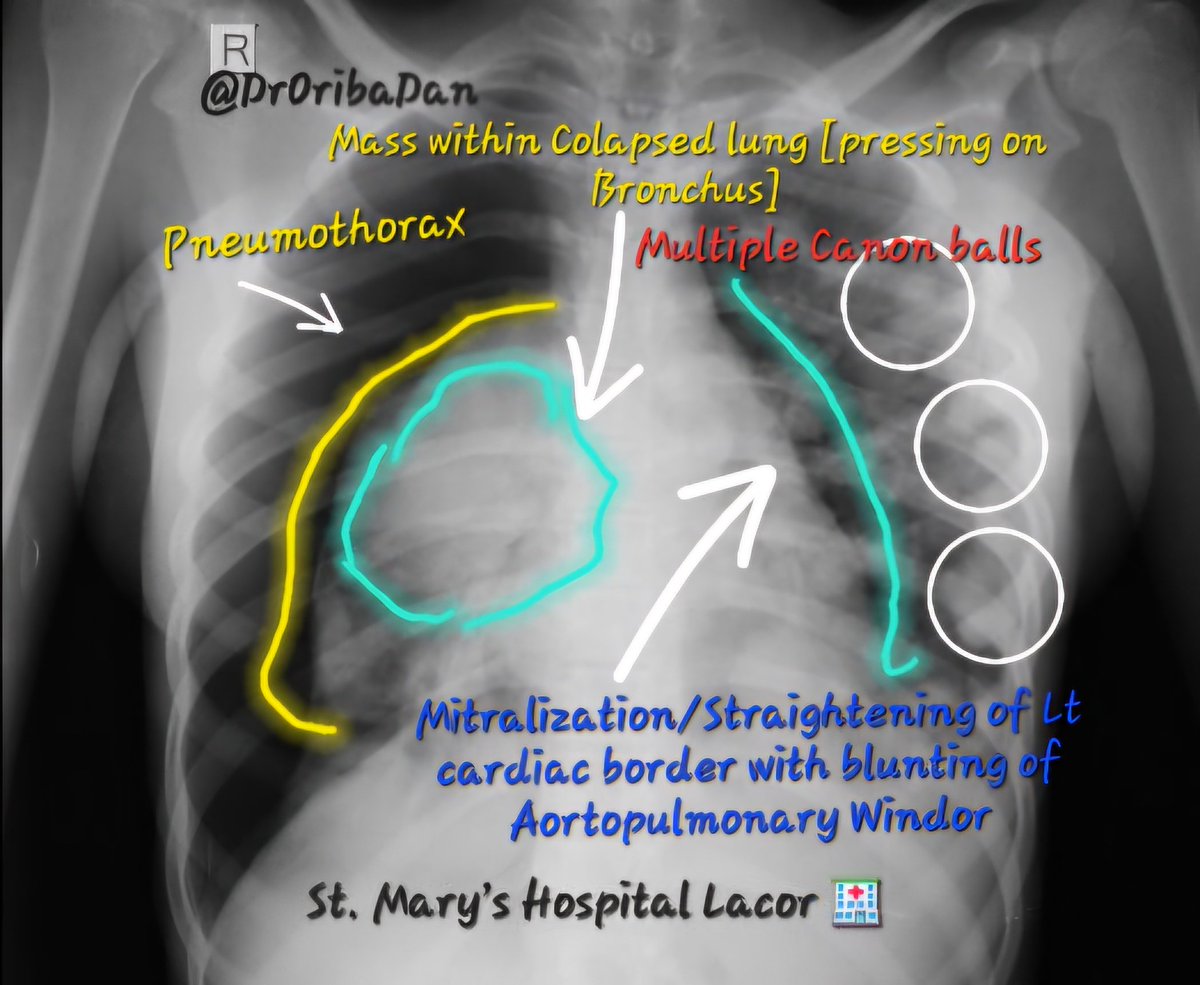 This Xray has multiple Pathologies 
1- Non Tension Pneumothorax [Trachea is Central]
2-Rt lung 🫁 collapse with a Mass pressing on Rt Principle Bronchus
3-Multiple Canon balls Metastasis 
[Lt &amp; Rt]
4-Mitralization/straightening of the Lt Heart border ⏭️Lt atrial enlargement &amp; HF