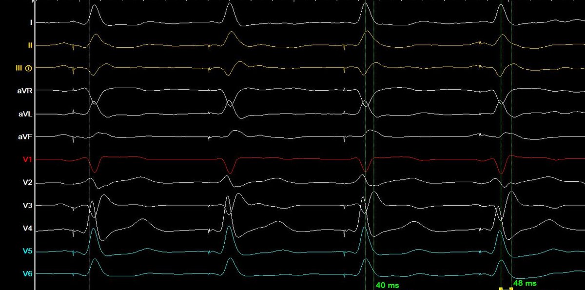 Enes Elvin Gul, MD, FESC, FEHRA (@enes_elvin) on Twitter photo No clear transition in V1 despite good penetration. However check V3, which is lower ICS with clear transition from ns-LBp to s-LBP. <a href="/curilakarol/">curilakarol</a> <a href="/alsertdemir/">dr_alsertdemir</a> <a href="/ugurcanpolatmd/">Ugur Canpolat</a> #Epeeps No clear transition in V1 despite good penetration. However check V3, which is lower ICS with clear transition from ns-LBp to s-LBP. <a href="/curilakarol/">curilakarol</a> <a href="/alsertdemir/">dr_alsertdemir</a> <a href="/ugurcanpolatmd/">Ugur Canpolat</a> #Epeeps