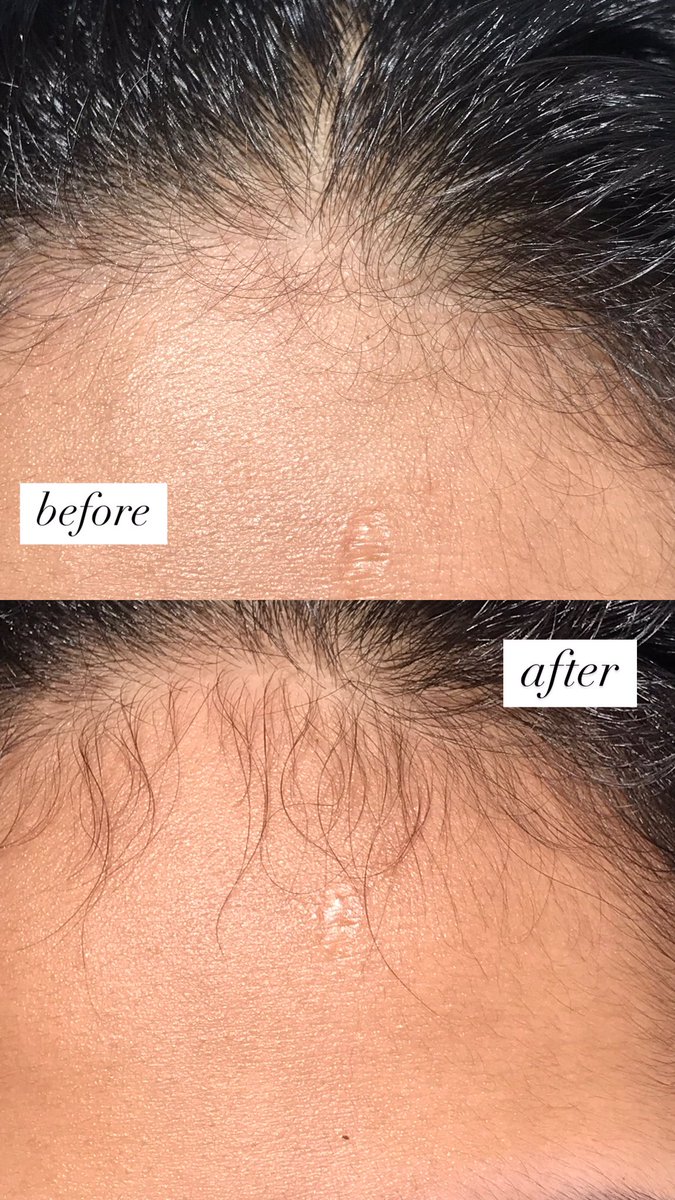 alkenaku's tweet photo. Akhir-akhir ini lagi cobain rosemary hair oil dan surprisingly hasilnya bikin aku seneng! 😭🫶

Baby hair aku tumbuh banyak bgt dan rambut rontok berkurang drastis🥹👌 https://t.co/zw9U8uwge8
