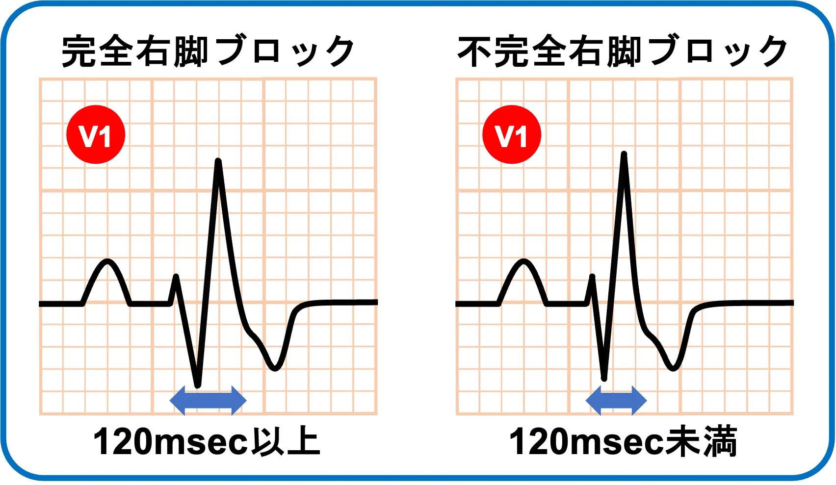 心電図 不 完全 右 脚 ブロック