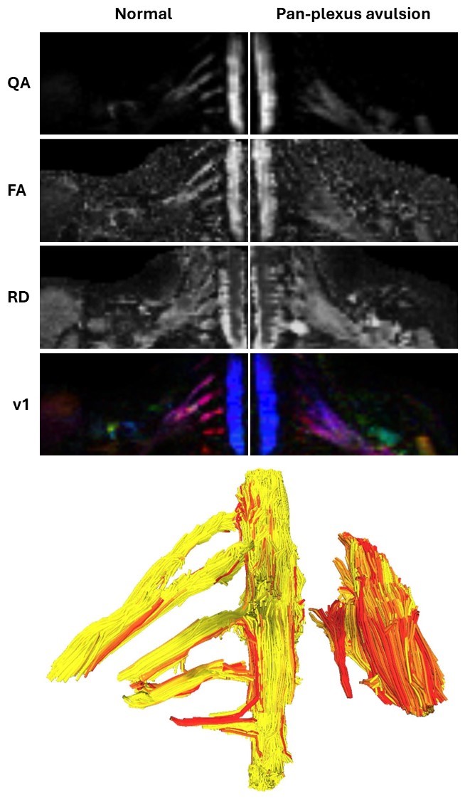 Ryckie Wade (@ryckiewade) on Twitter photo Diffusion tensor #MRI is sensitive to early microstructural changes in traumatic root avulsions in adults with brachial plexus injuries
Open-access 👉 doi.org/10.1016/j.nicl…
4 help setting up DM me
#DTI #BPI #tBPI <a href="/NIHRresearch/">National Institute for Health and Care Research</a> <a href="/LeedsPlastics/">Leeds Department of Plastic Surgery</a> <a href="/UniversityLeeds/">University of Leeds</a> <a href="/OpenResLeeds/">Open Research Leeds</a> Diffusion tensor #MRI is sensitive to early microstructural changes in traumatic root avulsions in adults with brachial plexus injuries
Open-access 👉 doi.org/10.1016/j.nicl…
4 help setting up DM me
#DTI #BPI #tBPI <a href="/NIHRresearch/">National Institute for Health and Care Research</a> <a href="/LeedsPlastics/">Leeds Department of Plastic Surgery</a> <a href="/UniversityLeeds/">University of Leeds</a> <a href="/OpenResLeeds/">Open Research Leeds</a>