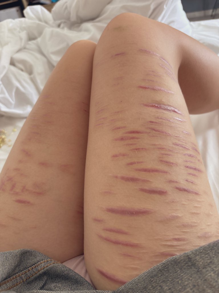 scars update!!