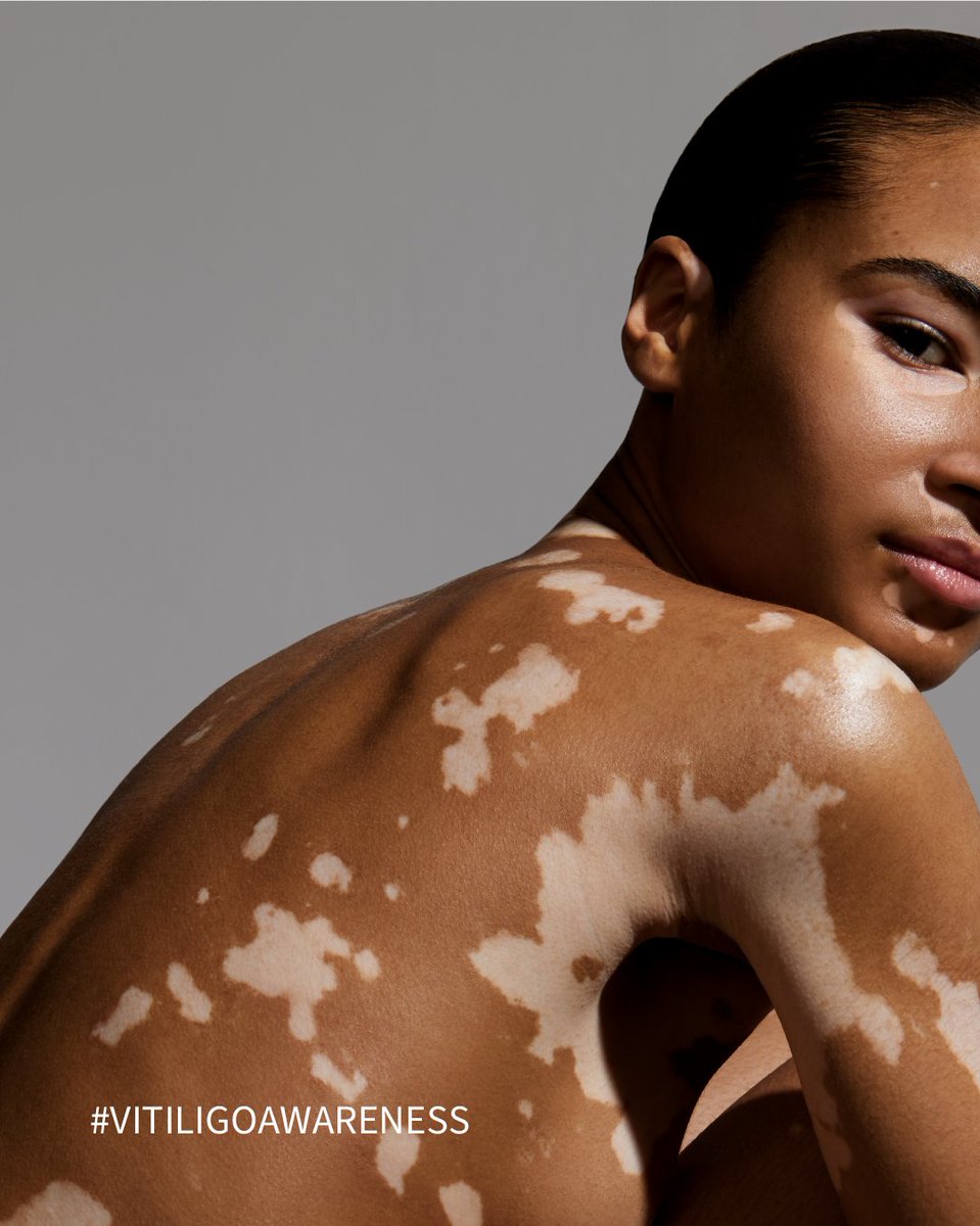 Treatment approaches for vitiligo have varied throughout history, from natural remedies to dietary changes.

In ancient India, treatment attempts included herbal pastes and sunlight exposure, while the others created creams from Psoralea corylifolia. 

More recently, therapies