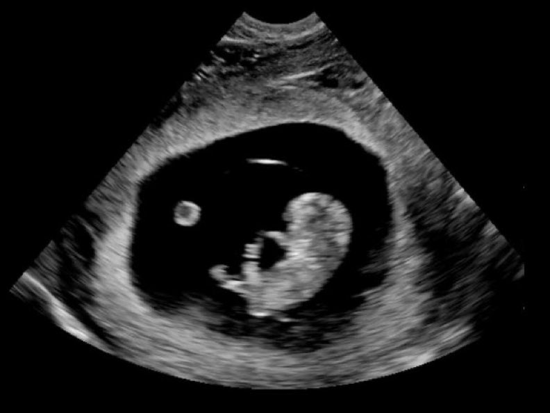 Tilden86's tweet photo. I know its been 4 years but those 4 years have been of misery and grief. I still can't move on. I wish I could see you grow into the strong man you would have become. I love you little Archibald Jr I hope to see you in heaven one day

#SingleMoms #miscarriage #JesusSaves #GRAMMYs https://t.co/AfCGyGt0R1