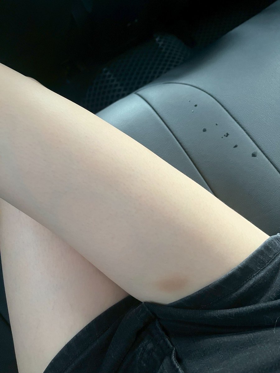 這瘀青是怎麼一回事^^？？