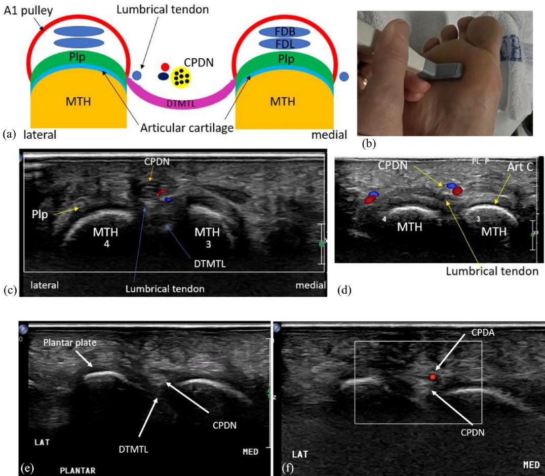Refine your anatomical knowledge and scanning approach with this open-access pictorial essay by Michelle Fenech:
 “Sonographic anatomy and technique to image the plantar digital nerves and aid identification of Morton’s neuroma.”
🔗rb.gy/dhw5nf
