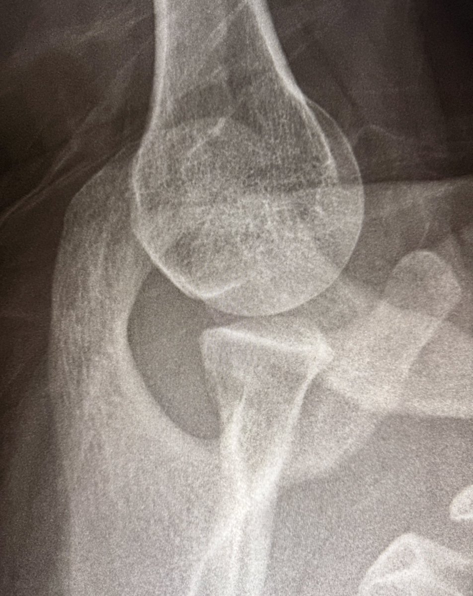 Tell me which is your favorite radiographic projection and why it is axillary view of the shoulder? 😅

Majestic! I have a soul crush on this view!