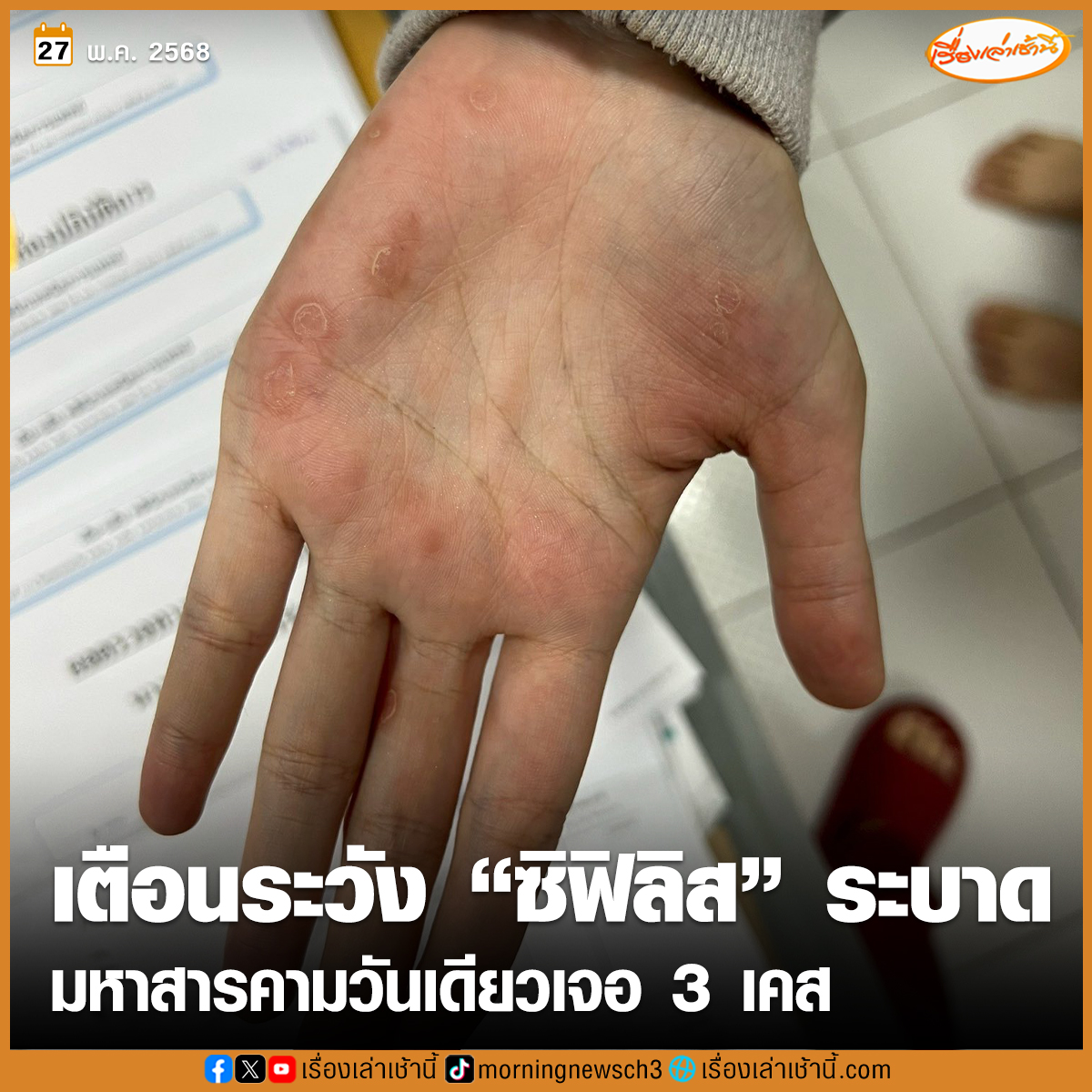 เตือนระวัง “ซิฟิลิส” ระบาดในกลุ่มนักศึกษา มหาสารคามวันเดียวโผล่ 3 ราย พบ 1 เคสพ่วง HIV สสจ.ชี้โรคติดต่อทางเพศสัมพันธ์แนวโน้มพุ่ง ขออย่าตระหนก แต่ให้ตระหนัก

อ่านข่าว : ch3plus.com/news/social/mo…

#เรื่องเล่าเช้านี้ #ข่าวช่อง3 #ข่าวสังคม