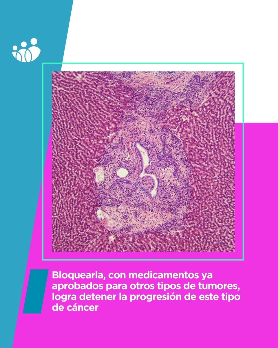 ACUNSA (@acunsa) on Twitter photo El colangiocarcinoma es un cáncer poco frecuente, pero de difícil tratamiento y mortalidad elevada.
<a href="/CIMA_unav/">Cima Universidad de Navarra</a> ha liderado un estudio internacional que ha detectado, en modelos preclínicos de ratón, una vía con gran potencial terapéutico. ¡Descúbrelo! bit.ly/494Ahyy El colangiocarcinoma es un cáncer poco frecuente, pero de difícil tratamiento y mortalidad elevada.
<a href="/CIMA_unav/">Cima Universidad de Navarra</a> ha liderado un estudio internacional que ha detectado, en modelos preclínicos de ratón, una vía con gran potencial terapéutico. ¡Descúbrelo! bit.ly/494Ahyy