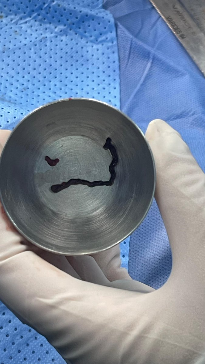 Leonardo Randial (@leonardorandial) on Twitter photo 4 y/o child with ischemic leg after hip re-do suegery. Fogarty still save limbs. <a href="/jmills1955/">Joseph L. Mills MD</a> <a href="/GAEscobarMD/">Guillermo Escobar🩸</a> <a href="/yuejianing/">Jianing Yue_Vas Surg in Shanghai</a> <a href="/DevinZarkowsky/">Devin Zarkowsky</a> <a href="/farkomd/">frank arko</a> <a href="/docpark/">W. Michael Park, MD</a> always separare stiches in small caliper vessel? 4 y/o child with ischemic leg after hip re-do suegery. Fogarty still save limbs. <a href="/jmills1955/">Joseph L. Mills MD</a> <a href="/GAEscobarMD/">Guillermo Escobar🩸</a> <a href="/yuejianing/">Jianing Yue_Vas Surg in Shanghai</a> <a href="/DevinZarkowsky/">Devin Zarkowsky</a> <a href="/farkomd/">frank arko</a> <a href="/docpark/">W. Michael Park, MD</a> always separare stiches in small caliper vessel?