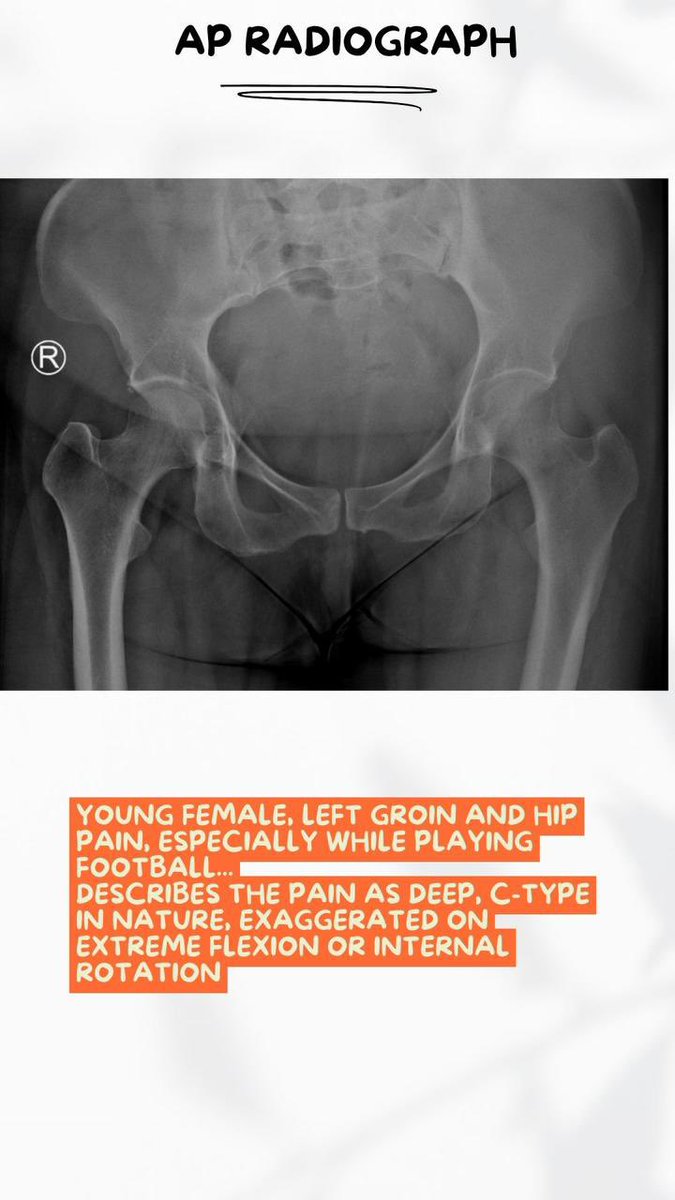 Femoroacetabular impingement (FAI) syndrome should only be applied to patients with a clinical disorder defined by the triad of:
1.Symptoms in young individuals
2.Clinical signs at physical examination
3.Characteristic radiological findings
As a clinical radiologist, our focus