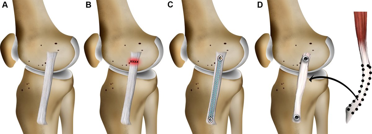 RadioGraphics (@radiographics) on Twitter photo The ACL is not the only ligament that can be repaired in the knee. Check out this article about imaging of non-ACL injuries and repairs. <a href="/thurlcledera/">Thurl Cledera</a> <a href="/StaceyGosiacoMD/">Stacey Gosiaco MD</a> <a href="/tatcantarelli/">Tatiane Cantarelli, MD</a> <a href="/dyannotdiane/">Dyan V. Flores</a> <a href="/uOttawaRad/">uOttawa Dept. Radiology, Rad Onc & Medical Physics</a> bit.ly/3Fpf1cp The ACL is not the only ligament that can be repaired in the knee. Check out this article about imaging of non-ACL injuries and repairs. <a href="/thurlcledera/">Thurl Cledera</a> <a href="/StaceyGosiacoMD/">Stacey Gosiaco MD</a> <a href="/tatcantarelli/">Tatiane Cantarelli, MD</a> <a href="/dyannotdiane/">Dyan V. Flores</a> <a href="/uOttawaRad/">uOttawa Dept. Radiology, Rad Onc & Medical Physics</a> bit.ly/3Fpf1cp