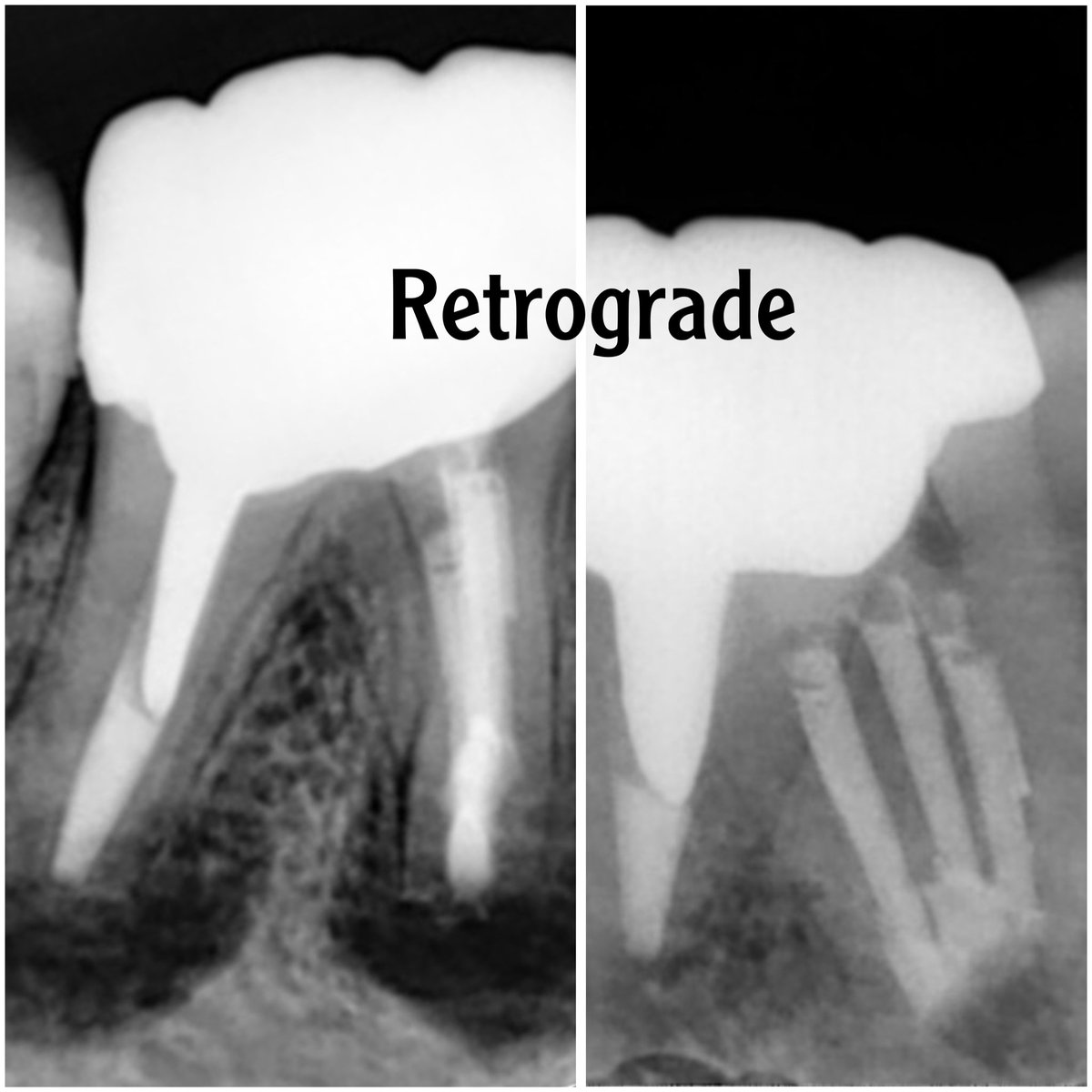 i_th44's tweet photo. - #46
- #Microsurery #SavingYourTeeth
- Full case :
https://t.co/uwlATrc5Pp https://t.co/BQzbFTTtx4