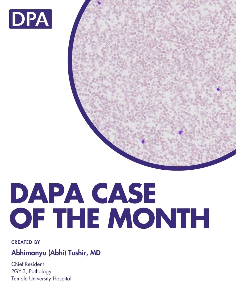 dpatweet's tweet image. A 25-year-old male presents with fatigue and mild jaundice. Laboratory studies reveal hemoglobin of 11.2 g/dL, MCV of 85 fL, and increased reticulocyte count. The direct antiglobulin test (DAT) is negative.
Take the assessment: zurl.co/2fX2g