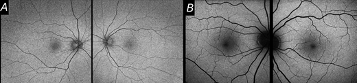 TVST Journal (@arvotvst) on Twitter photo Omar Mahroo et al. <a href="/UCLeye/">UCL Institute of Ophthalmology</a> explore Discrepancies Between Autofluorescence Imaging Modalities in CNGB3-Associated Achromatopsia and Correlation With Ellipsoid Zone Continuity, tvst.arvojournals.org/article.aspx?a…. Omar Mahroo et al. <a href="/UCLeye/">UCL Institute of Ophthalmology</a> explore Discrepancies Between Autofluorescence Imaging Modalities in CNGB3-Associated Achromatopsia and Correlation With Ellipsoid Zone Continuity, tvst.arvojournals.org/article.aspx?a….