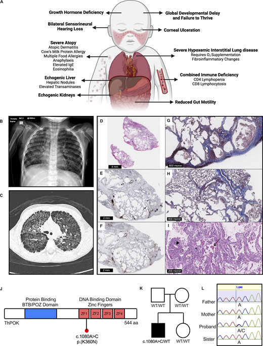 Journal of Experimental Medicine (@jexpmed) on Twitter photo A multimorphic variant in ThPOK causes #InbornErrorsOfImmunity with T cell defects and #fibrosis, say Maryam Vaseghi-Shanjani (<a href="/vaseghi_maryam/">Maryam Vaseghi-Shanjani</a>), Mehul Sharma, Catherine M. Biggs, Stuart E. Turvey et al. <a href="/TurveyLab/">Turvey lab</a>
hubs.la/Q03nlKfG0 A multimorphic variant in ThPOK causes #InbornErrorsOfImmunity with T cell defects and #fibrosis, say Maryam Vaseghi-Shanjani (<a href="/vaseghi_maryam/">Maryam Vaseghi-Shanjani</a>), Mehul Sharma, Catherine M. Biggs, Stuart E. Turvey et al. <a href="/TurveyLab/">Turvey lab</a>
hubs.la/Q03nlKfG0