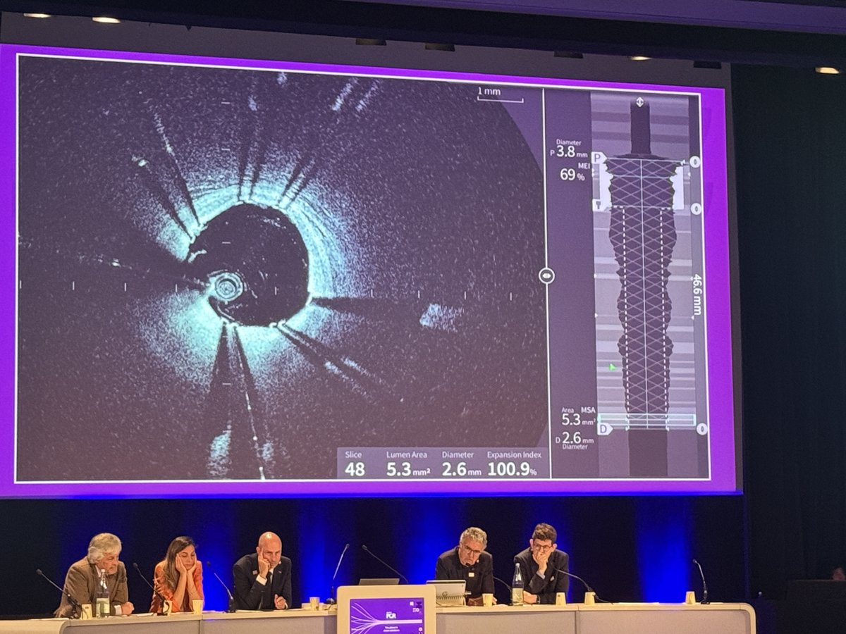What a week! Gentuity’s HF-OCT shined in multiple live cases at #EuroPCR, showcasing its power in complex PCI:

 🔬 Ultra-high resolution, crystal-clear images
 ⚡ Lightning-fast pullbacks
 💡 Real-time clinical confidence

Huge thanks to the physicians, cath lab teams!