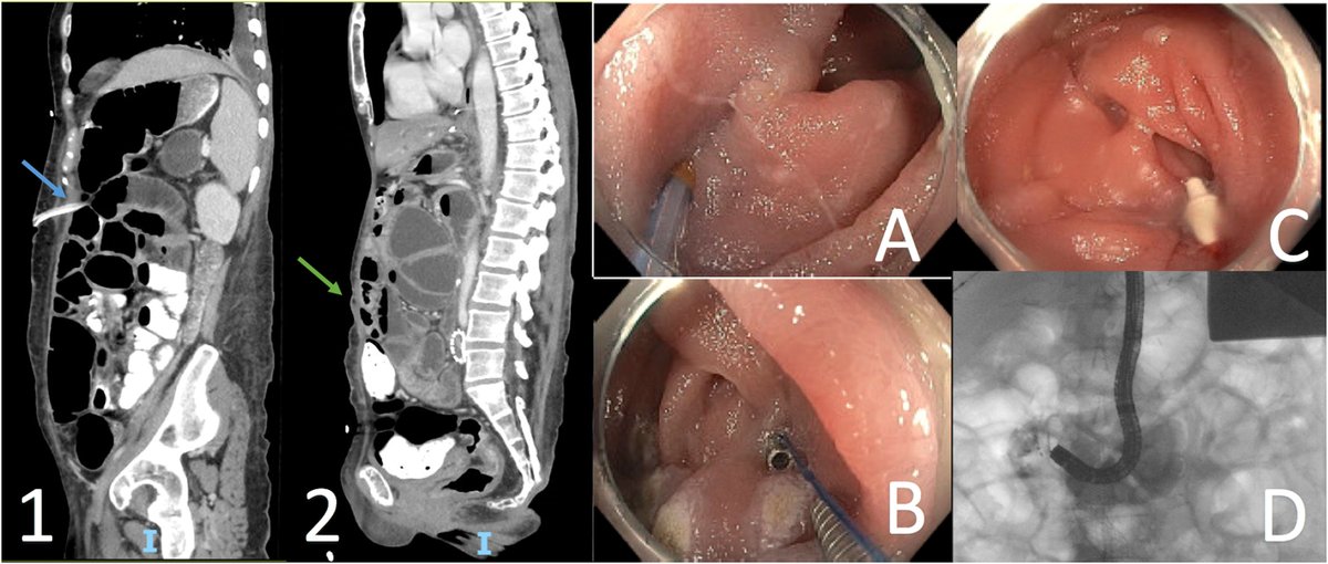TIGE (@aga_tige) on Twitter photo πΈ Check out this case series!
π Utilization of Through-the-scope Sutures for Complex Tissue Apposition: A Series of Novel Cases
π ow.ly/fQHF50VXUKH πΈ Check out this case series!
π Utilization of Through-the-scope Sutures for Complex Tissue Apposition: A Series of Novel Cases
π ow.ly/fQHF50VXUKH